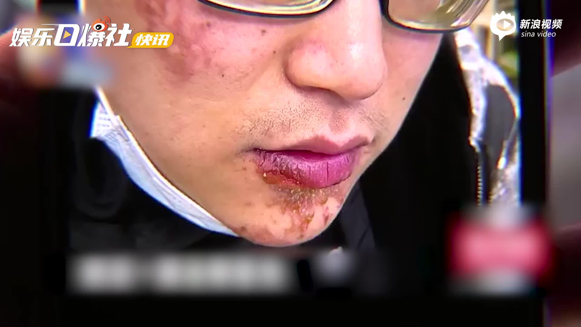 陈赫火锅店天花板掉落伤顾客