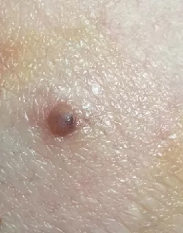 这个痣是肝癌信号快看看自己身上有没有