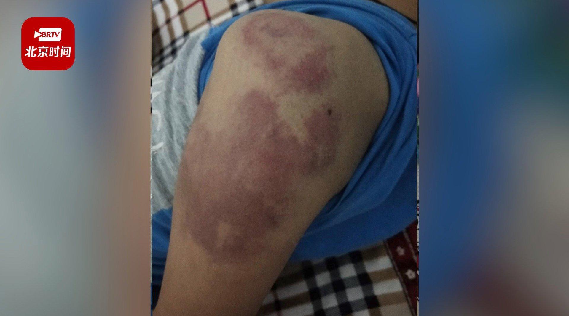 家长自曝一年级孩子遭老师殴打致胳膊淤青 教体局:已经介入,双方将