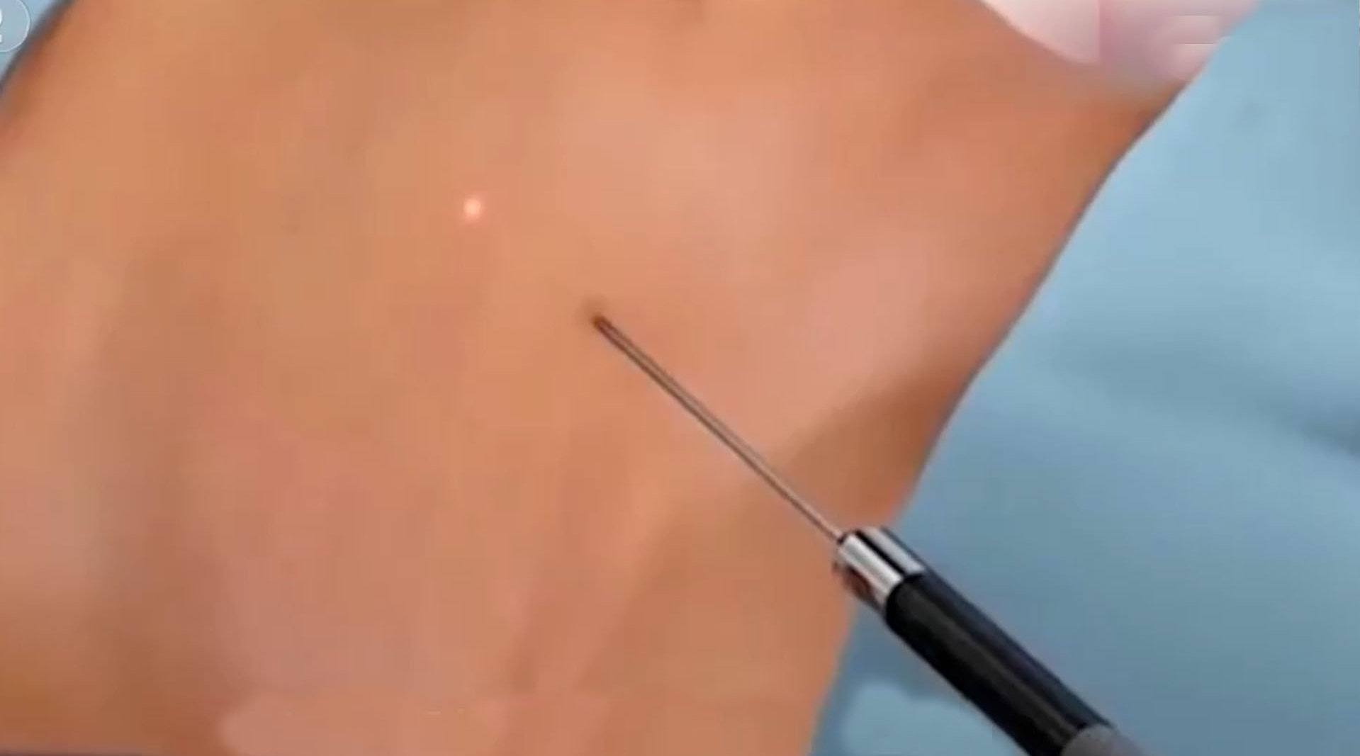 央视调查：抽脂适合所有人吗？该如何选医院？