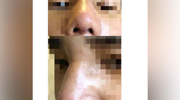 济南喜悦整形男性顾客发声：肋骨鼻术失败，修复两次致鼻歪斜