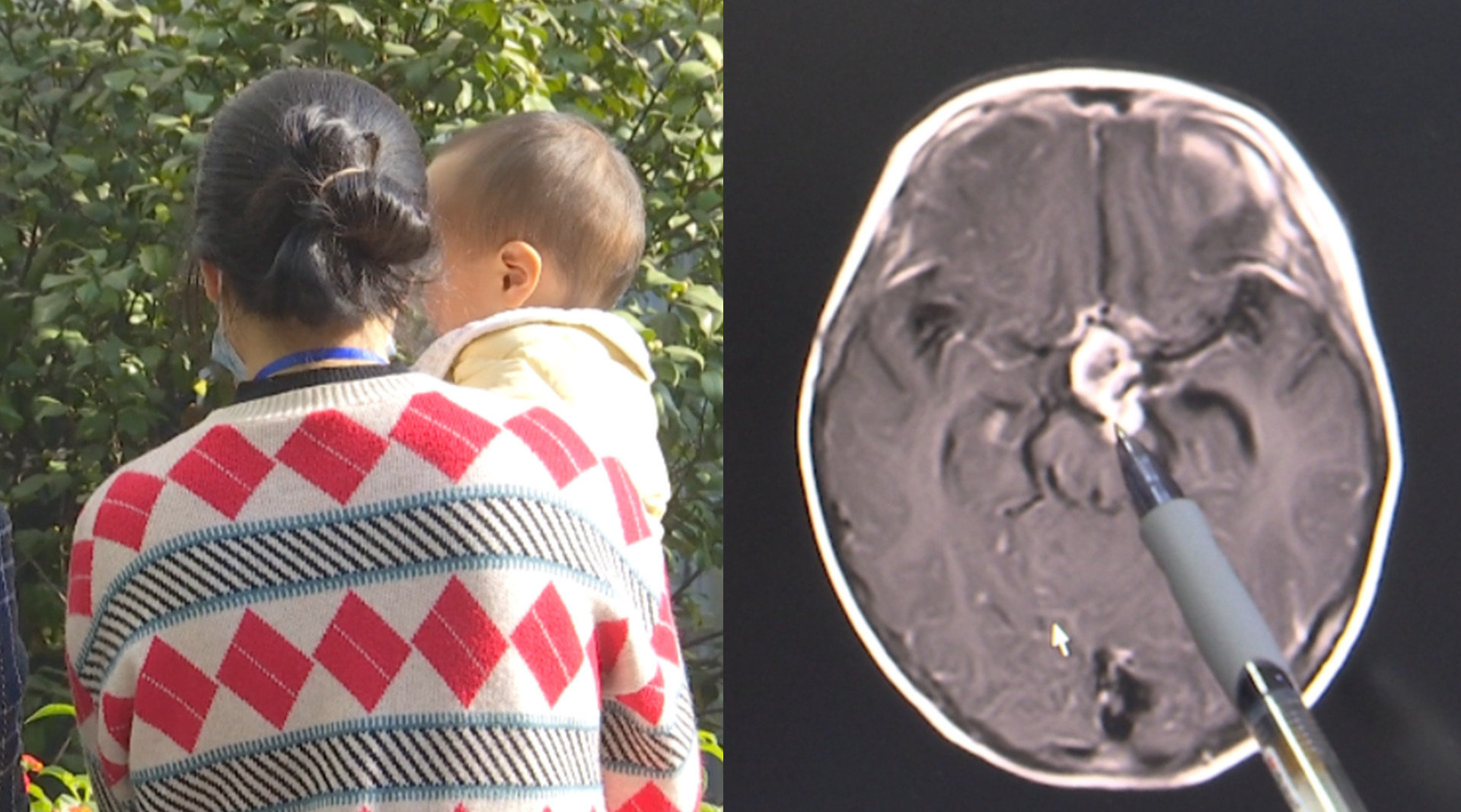 5岁幼儿突发头痛,呕吐,就医查出脑内3厘米恶性肿瘤