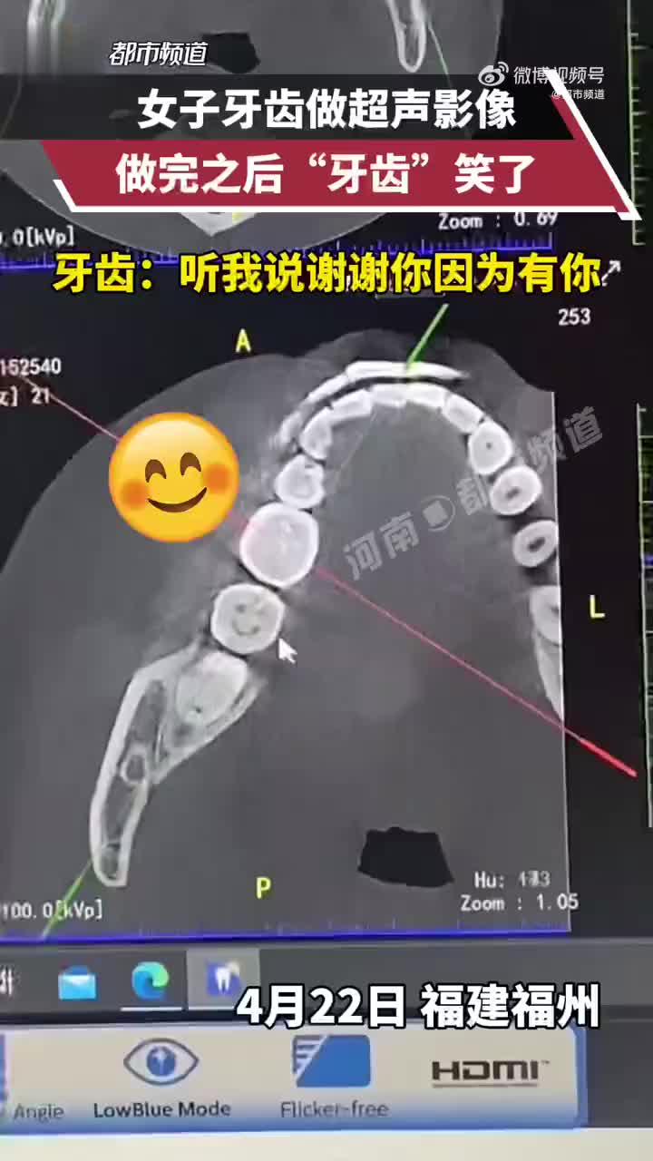 拍牙齿ct发现蛀牙蛀成一张笑脸