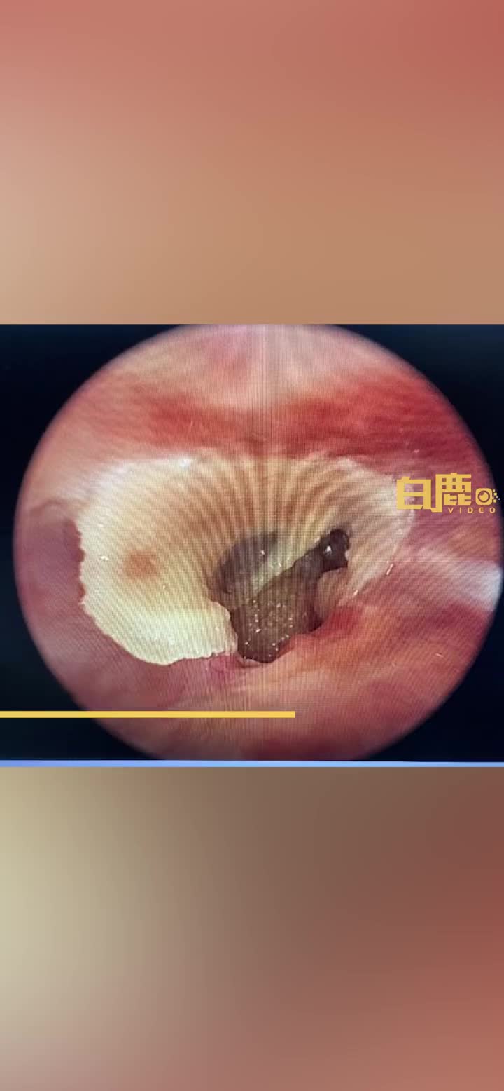 28岁男子误用502滴耳半年后就医鼓膜穿孔耳朵持续流脓才就医