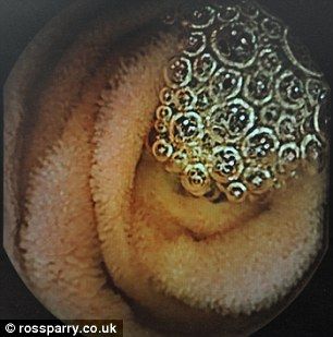 尽管用传统医疗设备可成功扫描食道、胃和大肠等身体部分，但内脏和小肠（胶囊内试镜拍到的照片）等其他器官无法用内窥镜进行观察。内窥镜是一根末端配有相机的柔软的细长管子。