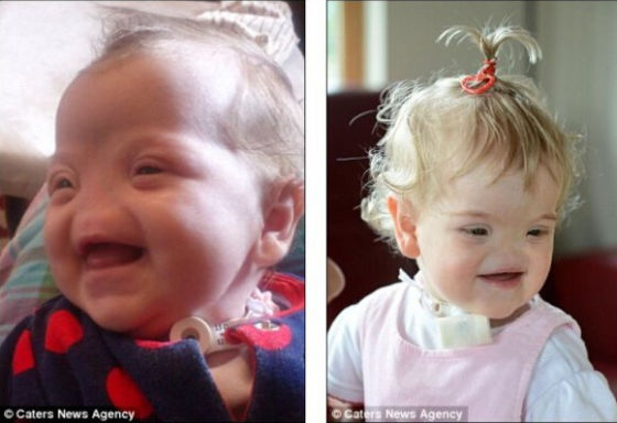 特莎·伊文思患有罕见的先天性失鼻症