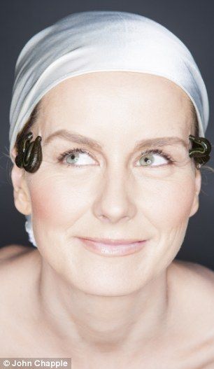 艾玛·帕克·鲍尔斯希望水蛭疗法能帮助她摆脱偏头痛的困扰