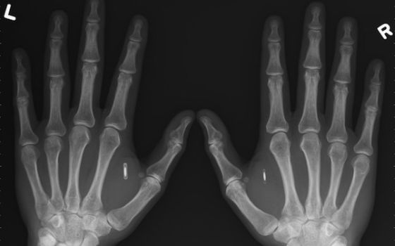 手部植入NFC芯片