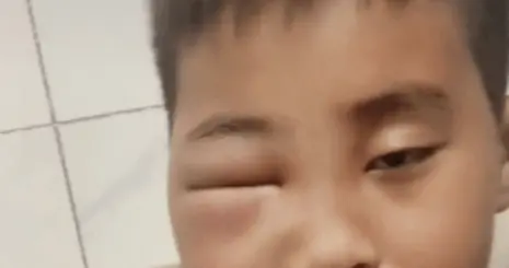 小男孩拿棍子捅蜂窝脸肿成球，妈妈发声：他可能觉得蜜蜂好玩