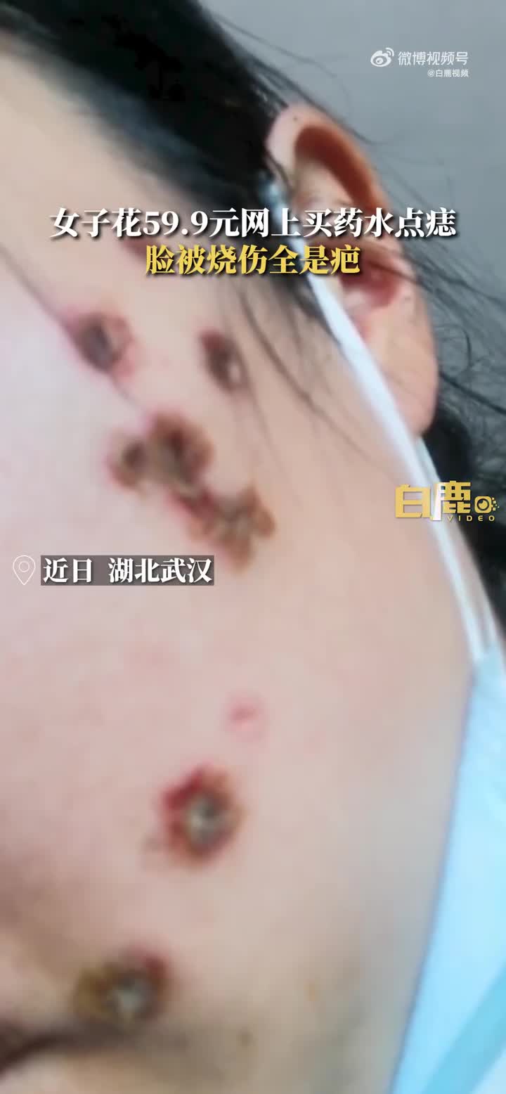 女子59元网购药水点痣脸被烧伤留疤