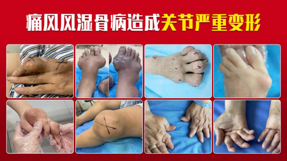 6月3-4北京大学人民医院李玉慧教授痛风风湿骨病会诊开始预约