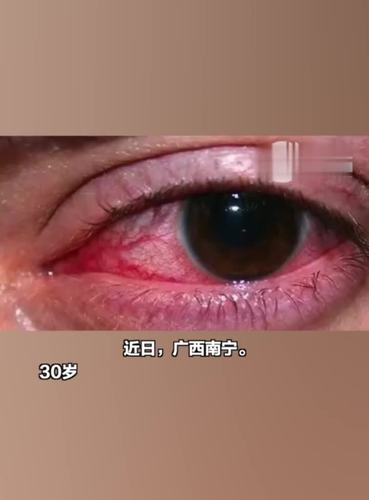 曾用酒店毛巾擦拭身体!南宁一男子莫名染上淋病