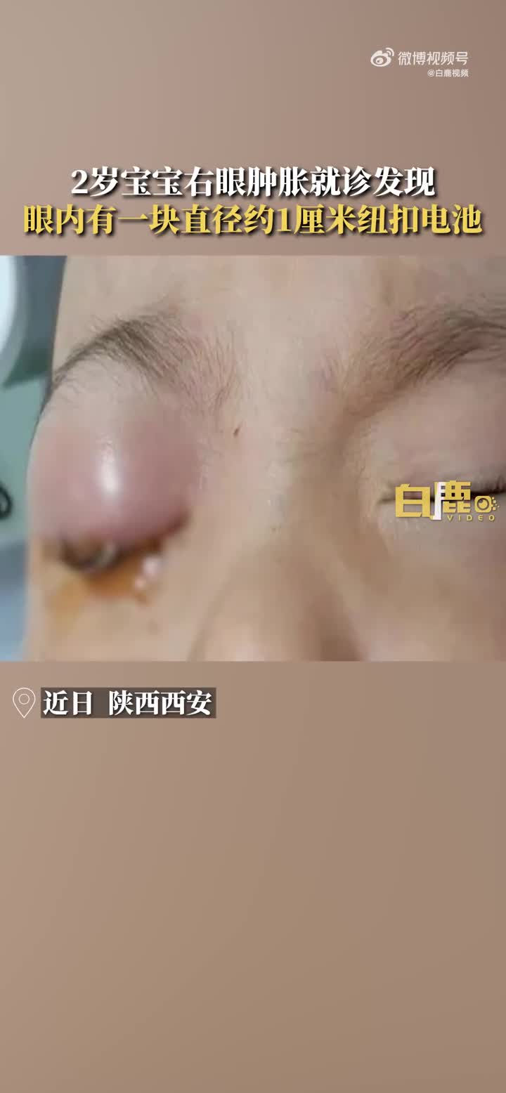 2岁宝宝眼肿流脓就医取出一块电池_新浪财经_新浪网