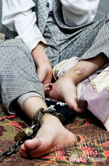 为了挣脱锁链，孩子找人开锁，却弄伤了左脚