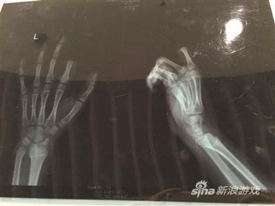 X光片显示孩子食指两个指节被切断