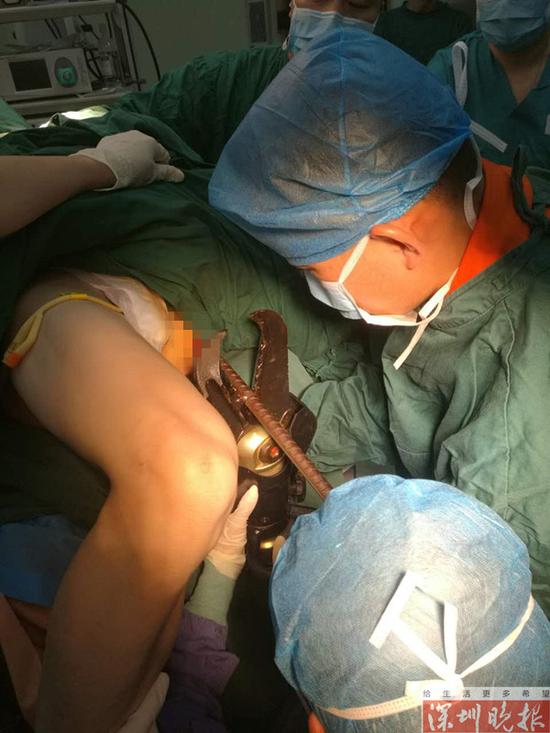 工人被钢筋贯穿,消防员医生协力救助