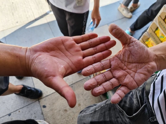 褪去防护服,医护人员双手早已被汗水浸透发白发胀