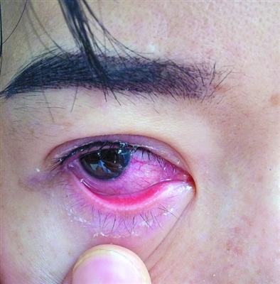 女子纹美瞳线纹出双眼红肿医院诊断眼角膜受损