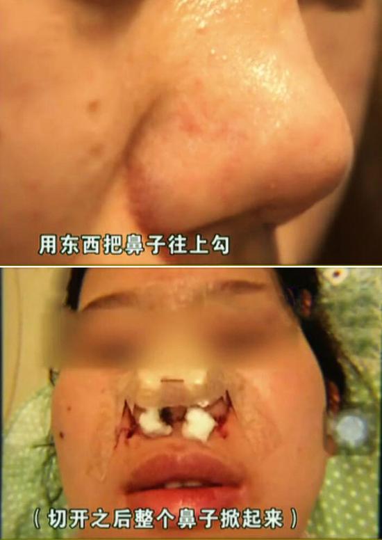手术操作不当2妙龄女分别做隆鼻隆胸术感染惨遭毁容
