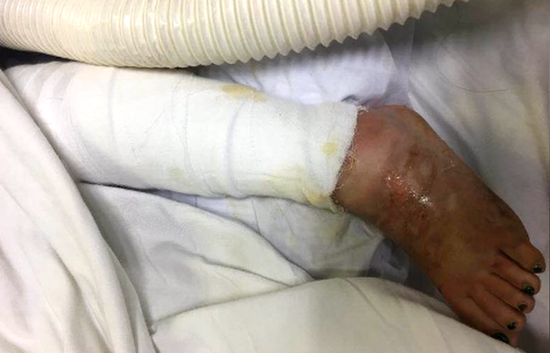 中山市24岁女孩重度烧伤 母亲探望途中车祸身亡