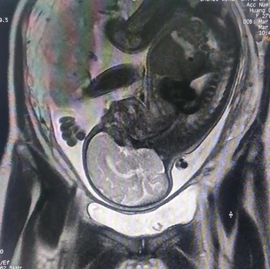 胎儿核磁的蛋蛋图像图片