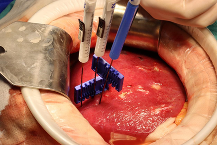 深圳第一台纳米刀带来癌症治疗新希望