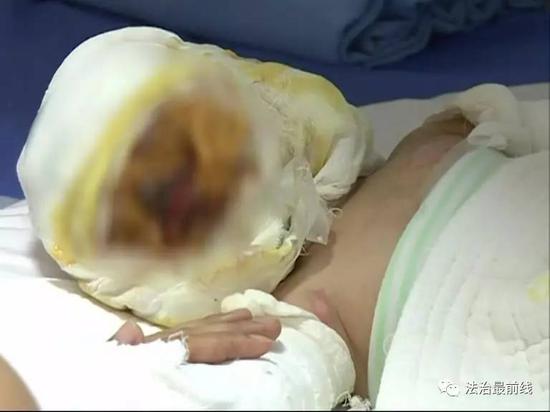 桂林女童被烧成特重度烧伤