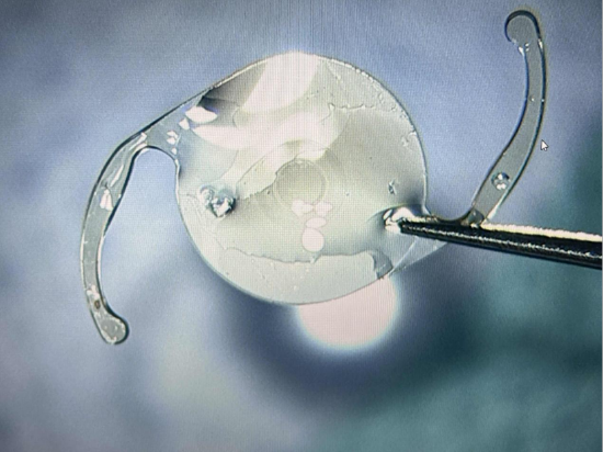 国内首批非衍射景深延长型人工晶体植入成功76岁程女士术后一天实现