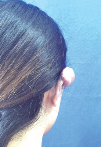 21岁女孩打耳洞后耳朵长出"鸽子蛋"