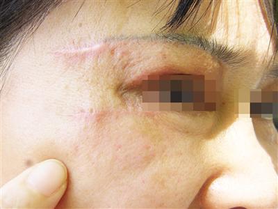 眼袋手术遭毁容左眼看不清万宁女子起诉索赔30万