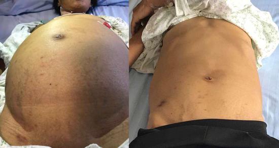 澄迈5旬女子腹大如"鼓" 原因竟是得了这种罕见病