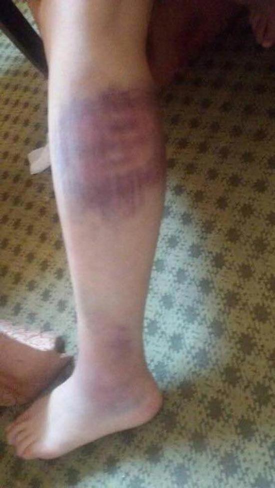 张奎梅曾拍下当时张晓燕的伤痕,这样的淤青遍布全身,彼时张晓燕的左