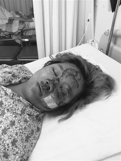 拖拉机撞倒骑电动车女子后逃逸伤者身体多处骨折