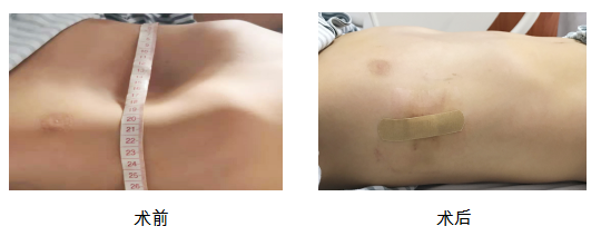 漏斗胸是一种先天性疾病,是非常常见的胸廓畸形,发病率在0.2-0.