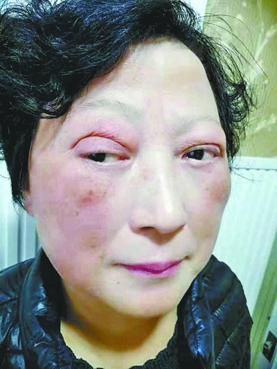 割坏双眼皮21年不敢出门女子整形修复后补拍婚纱照