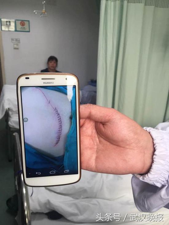 武汉23岁海归刑警勇斗扒手腹部被刺伤缝了22针