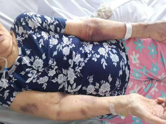 华法林过量,导致皮下组织出血