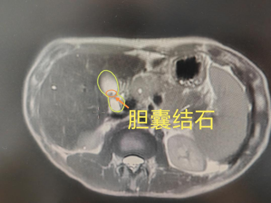 患者体内的胆囊结石