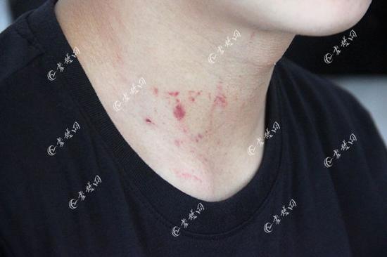 王子健的脖子处有一大块掐痕