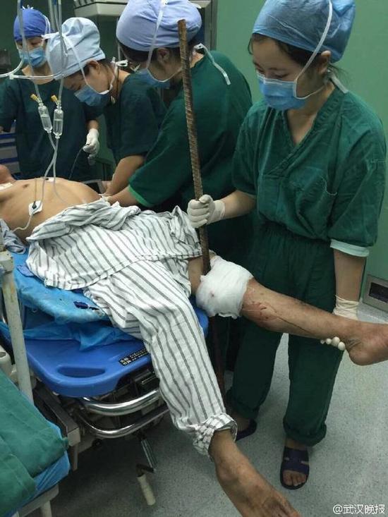 武汉一工人不慎从5米高坠落大腿被钢筋扎穿血流如注