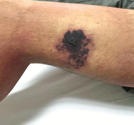 男子被蜘蛛咬一口后中毒经紧急救治病情已稳定