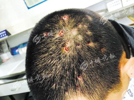 男子游玩惊动马蜂 脑袋被蜇成马蜂窝致肾衰竭