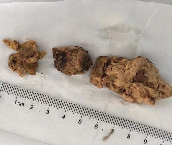 胃柿石 新浪网