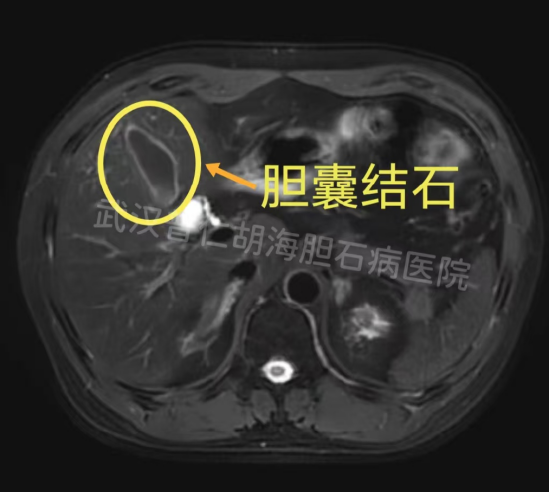 患者胆囊内5厘米的大结石