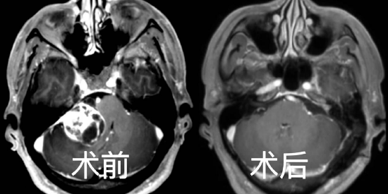 听力下降,伴有耳鸣?警惕听神经瘤