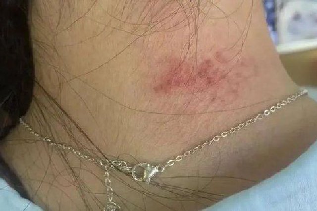 女子戴合金項(xiàng)鏈患皮炎 有合金首飾重金屬超標(biāo)1000多倍