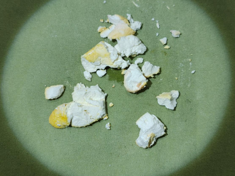 患者胆囊内的“石膏样”结石