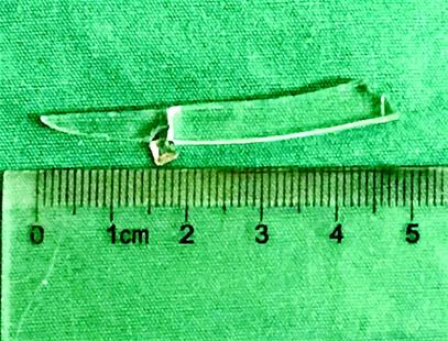 5厘米长的玻璃在男子眼眶躺了近1个月现已成功取出