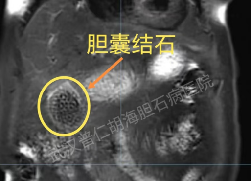 患者胆囊内填满结石