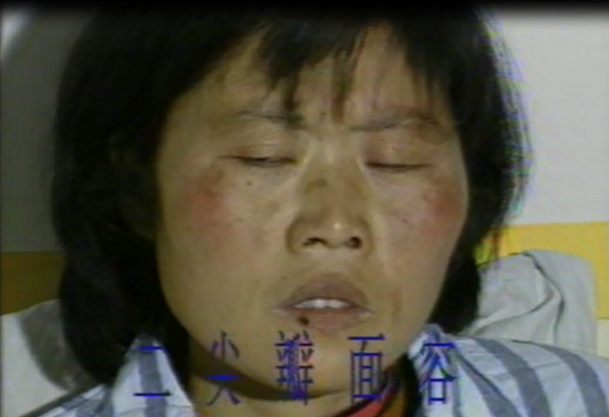 朱丹教授心脏瓣膜病外科治疗的修复与置换之争